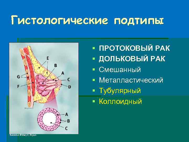 Гистологические подтипы § § § Illustration © Mary K. Bryson ПРОТОКОВЫЙ РАК ДОЛЬКОВЫЙ РАК