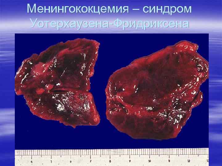 Менингококцемия – синдром Уотерхаузена-Фридриксена 