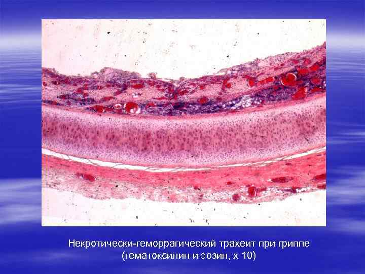 Некротически-геморрагический трахеит при гриппе (гематоксилин и эозин, х 10) 