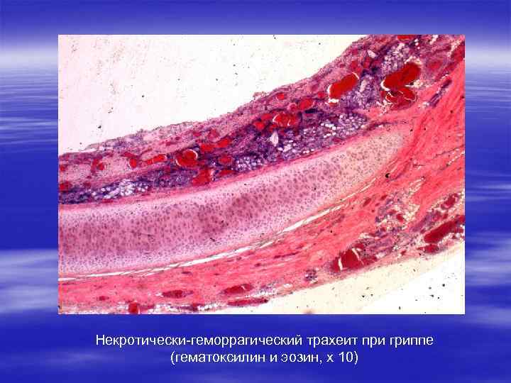 Некротически-геморрагический трахеит при гриппе (гематоксилин и эозин, х 10) 