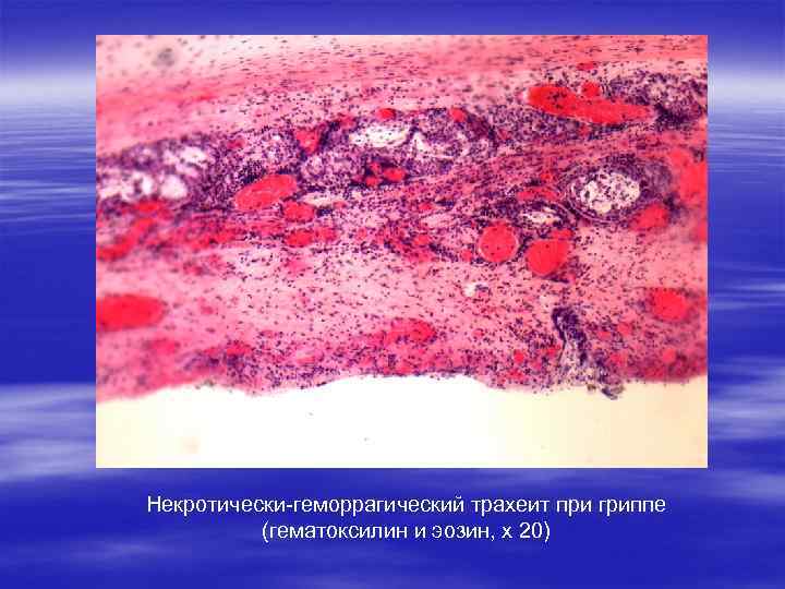 Некротически-геморрагический трахеит при гриппе (гематоксилин и эозин, х 20) 
