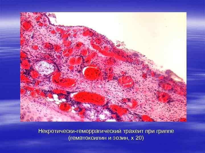 Некротически-геморрагический трахеит при гриппе (гематоксилин и эозин, х 20) 