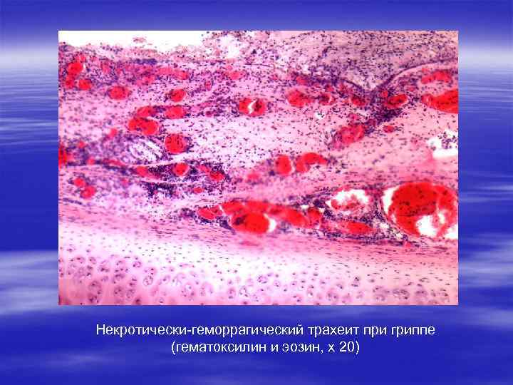 Некротически-геморрагический трахеит при гриппе (гематоксилин и эозин, х 20) 