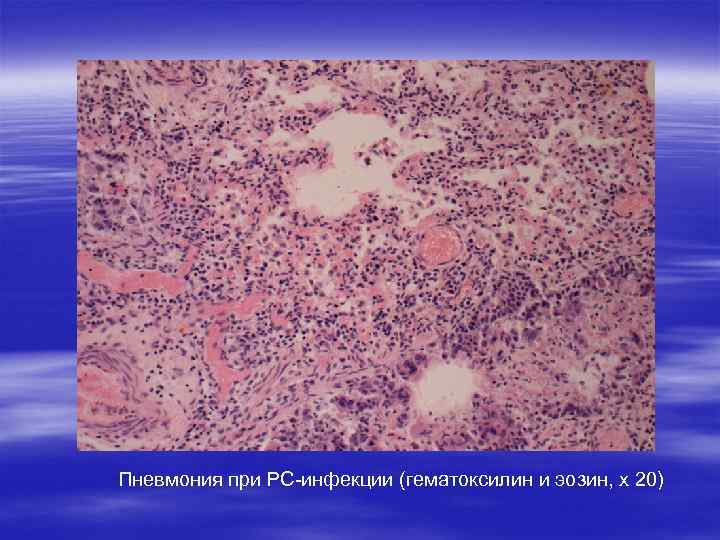 Пневмония при РС-инфекции (гематоксилин и эозин, х 20) 
