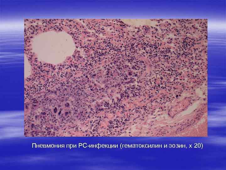 Пневмония при РС-инфекции (гематоксилин и эозин, х 20) 