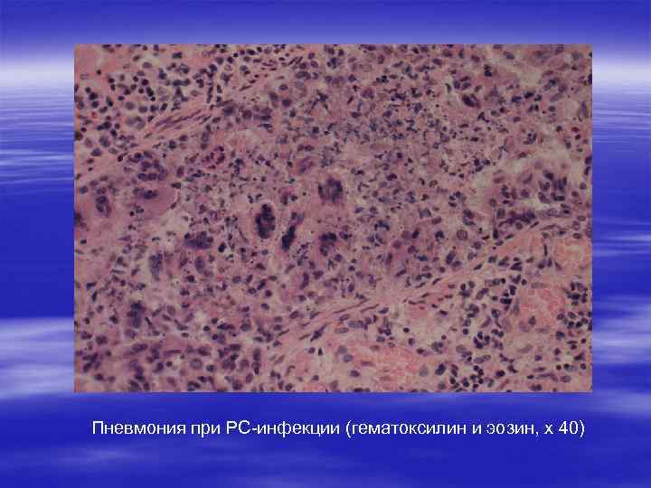 Пневмония при РС-инфекции (гематоксилин и эозин, х 40) 