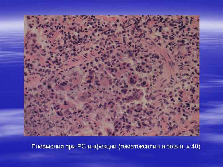 Пневмония при РС-инфекции (гематоксилин и эозин, х 40) 