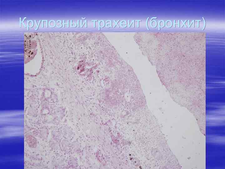 Крупозный трахеит микропрепарат рисунок