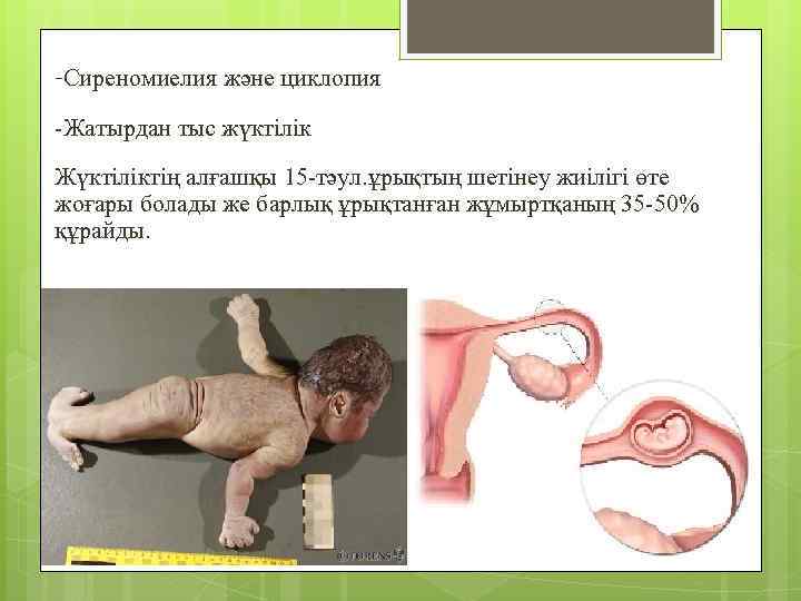 -Сиреномиелия және циклопия -Жатырдан тыс жүктілік Жүктіліктің алғашқы 15 -тәул. ұрықтың шетінеу жиілігі өте