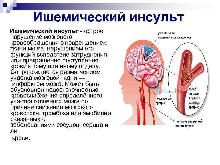 Ишемический инсульт острое нарушение мозгового кровообращения с повреждением ткани мозга, нарушением его функций вследствие