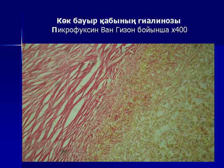 Көк бауыр қабының гиалинозы Пикрофуксин Ван Гизон бойынша х400 