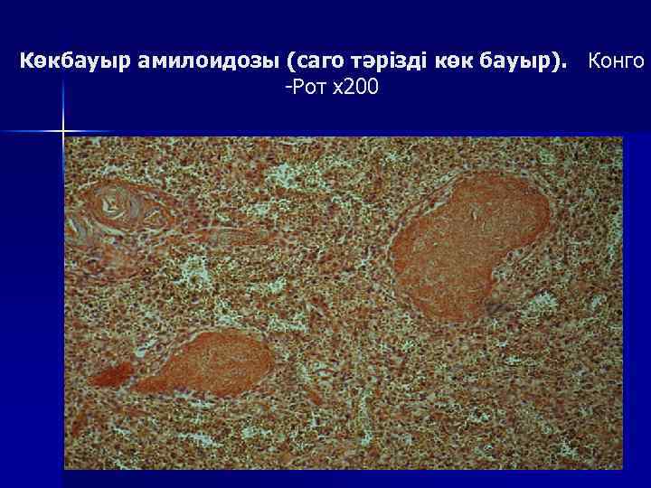 Көкбауыр амилоидозы (саго тәрізді көк бауыр). Конго -Рот х200 