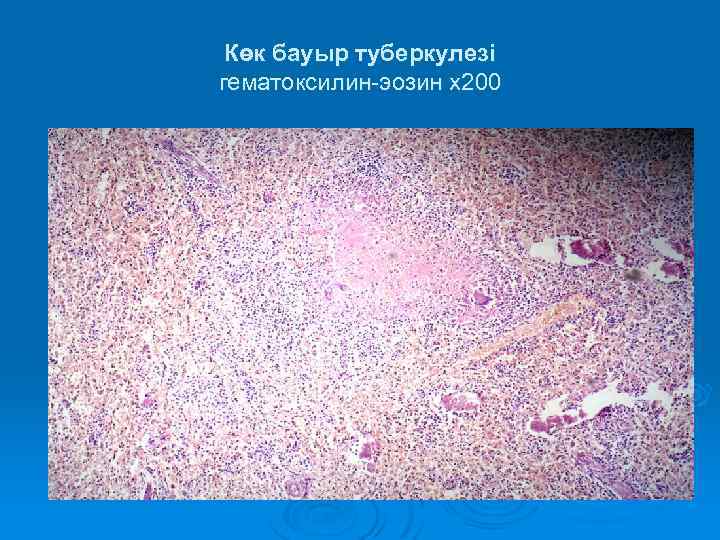 Көк бауыр туберкулезі гематоксилин-эозин х200 