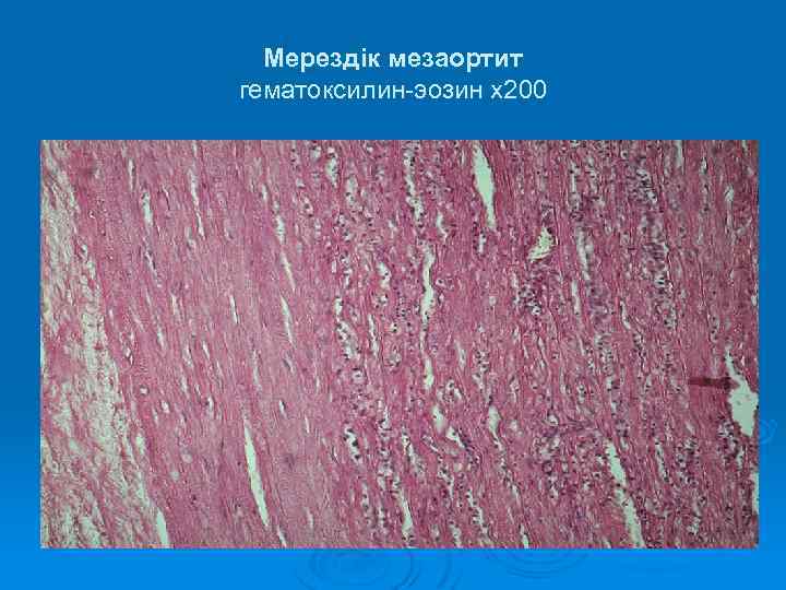 Мерездік мезаортит гематоксилин-эозин х200 