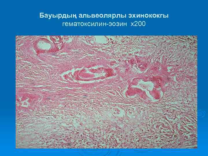 Бауырдың альвеолярлы эхинококгы гематоксилин-эозин х200 