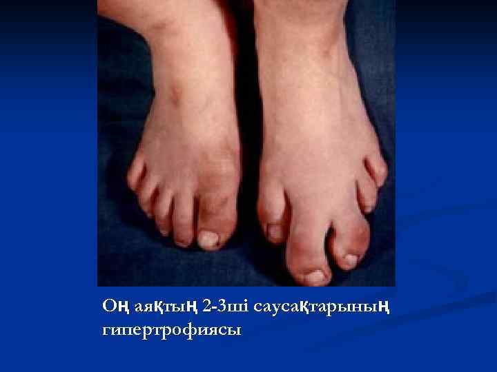 Оң аяқтың 2 -3 ші саусақтарының гипертрофиясы 
