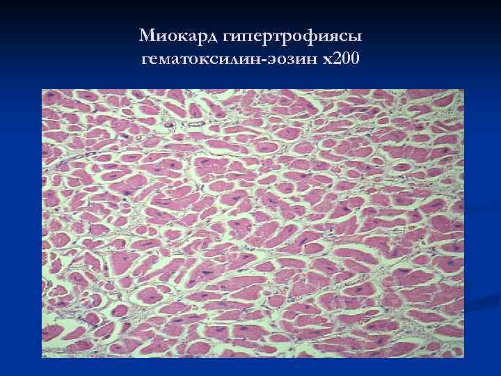 Миокард гипертрофиясы гематоксилин-эозин х200 