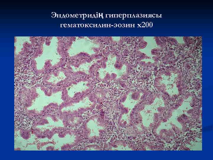 Эндометридің гиперплазиясы гематоксилин-эозин х200 