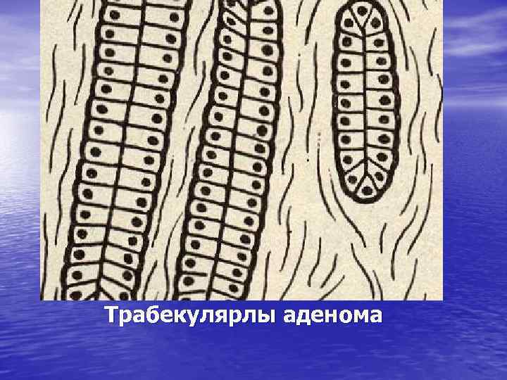 Трабекулярлы аденома 