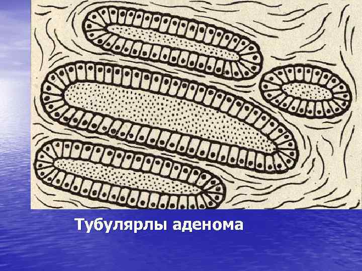 Тубулярлы аденома 