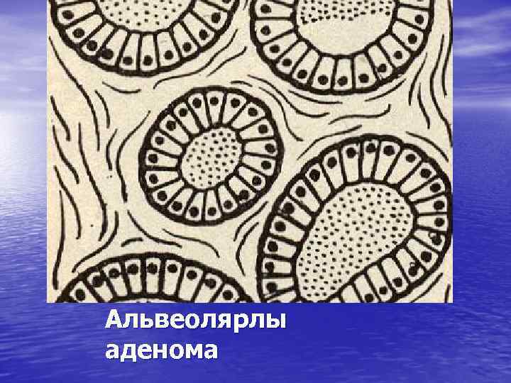 Альвеолярлы аденома 