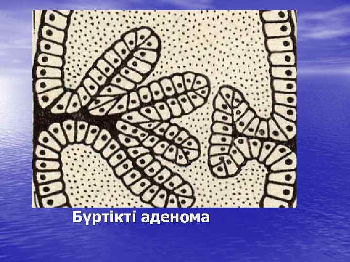 Бүртікті аденома 