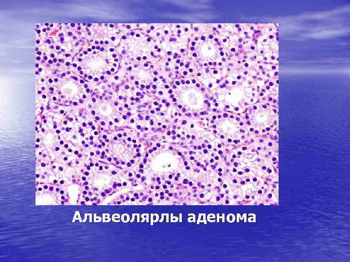 Альвеолярлы аденома 