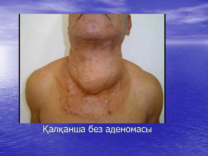 Қалқанша без аденомасы 