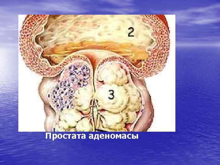 Простата аденомасы 