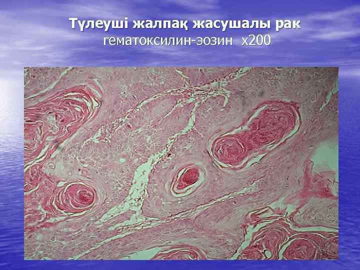 Түлеуші жалпақ жасушалы рак гематоксилин-эозин х200 