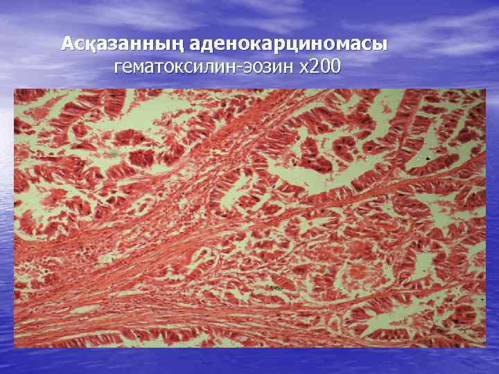 Асқазанның аденокарциномасы гематоксилин-эозин х200 