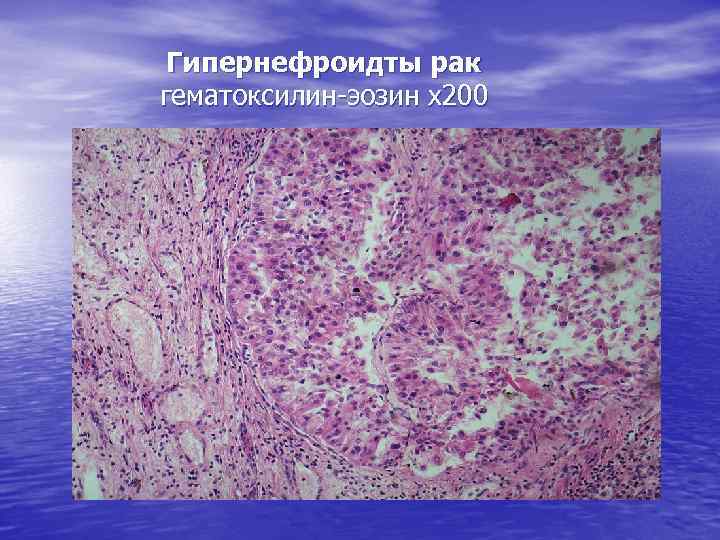 Гипернефроидты рак гематоксилин-эозин х200 