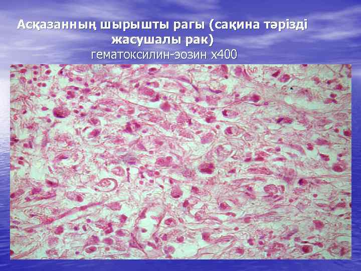 Асқазанның шырышты рагы (сақина тәрізді жасушалы рак) гематоксилин-эозин х400 