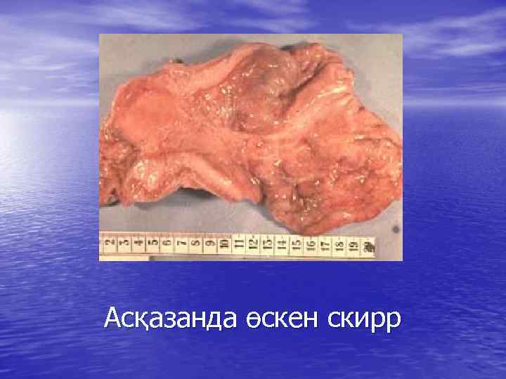 Асқазанда өскен скирр 