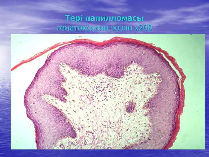 Тері папилломасы гематоксилин-эозин х200 