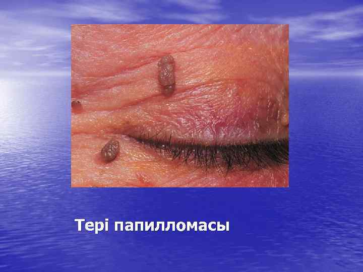 Тері папилломасы 