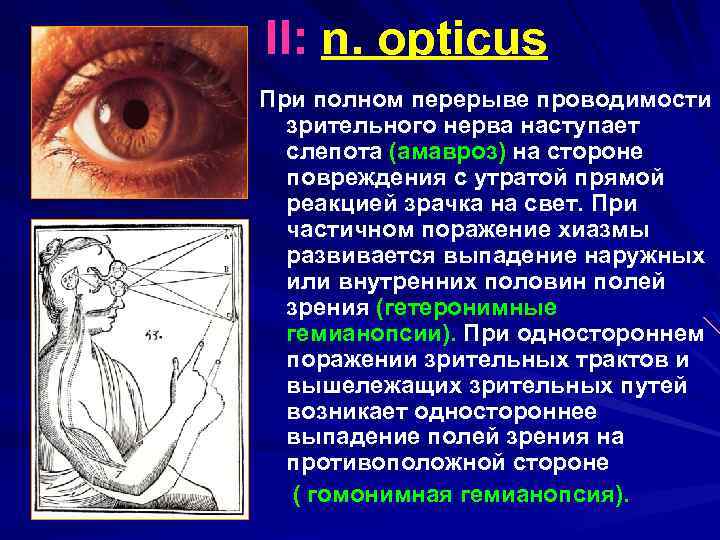  II: n. opticus При полном перерыве проводимости зрительного нерва наступает слепота (амавроз) на