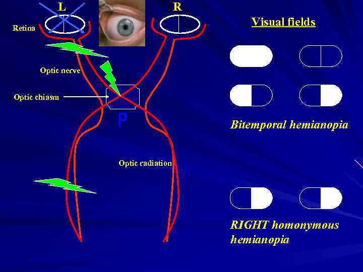 L R Visual fields Retina Optic nerve Optic chiasm Bitemporal hemianopia Optic radiation RIGHT