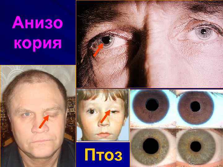 Анизо кория Птоз 