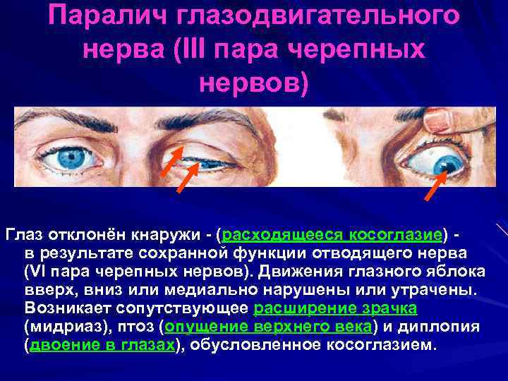 Паралич глазодвигательного нерва (III пара черепных нервов) Глаз отклонён кнаружи - (расходящееся косоглазие) в