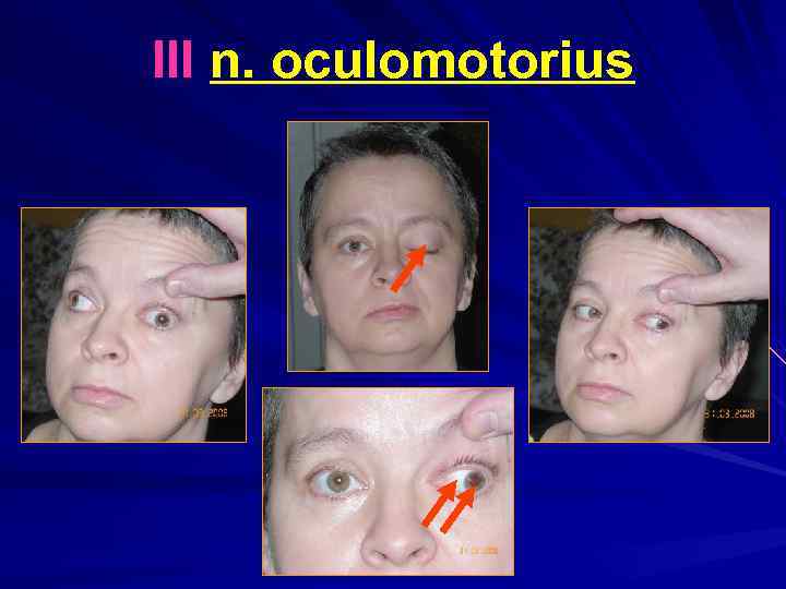 III n. oculomotorius 