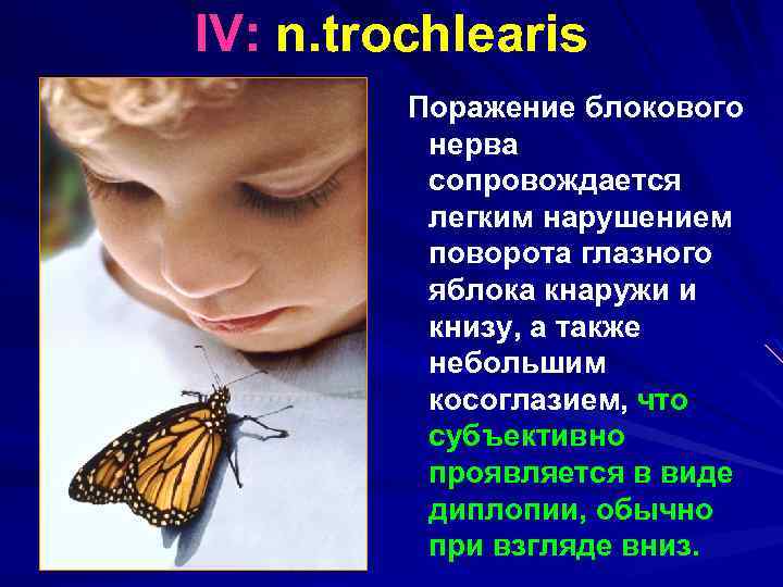 IV: n. trochlearis Поражение блокового нерва сопровождается легким нарушением поворота глазного яблока кнаружи и