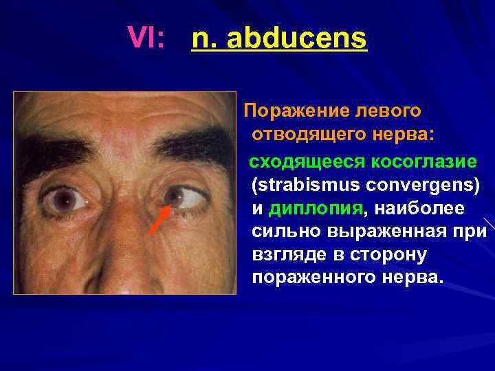 VI: n. abducens Поражение левого отводящего нерва: сходящееся косоглазие (strabismus convergens) и диплопия, наиболее