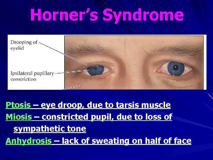 Horner’s Syndrome Ptosis – eye droop, due to tarsis muscle Miosis – constricted pupil,