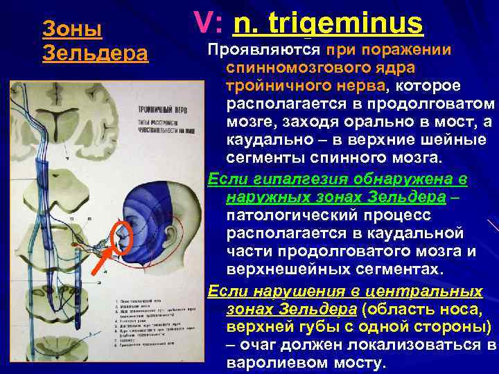  V: n. trigeminus Зоны Проявляются при поражении Зельдера спинномозгового ядра тройничного нерва, которое