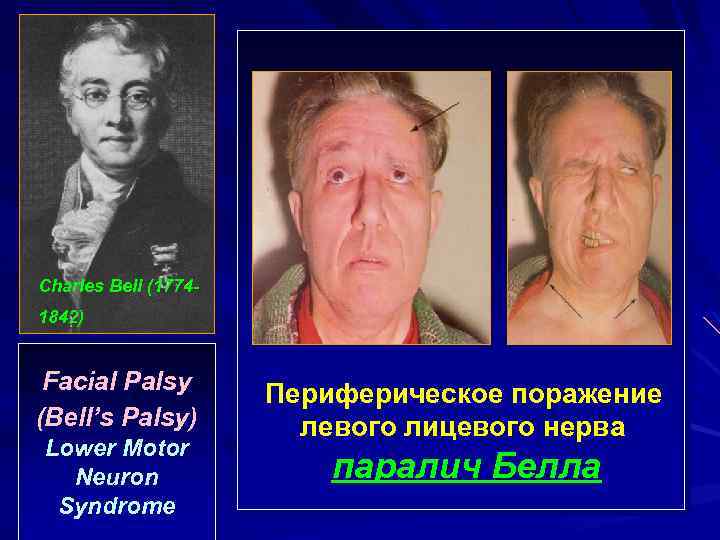 Charles Bell (17741842) Facial Palsy (Bell’s Palsy) Lower Motor Neuron Syndrome Периферическое поражение левого