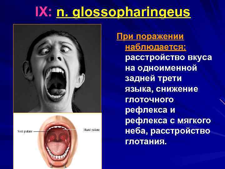 IX: n. glossopharingeus При поражении наблюдается: расстройство вкуса на одноименной задней трети языка, снижение