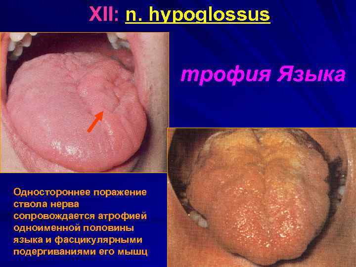XII: n. hypoglossus трофия Языка Одностороннее поражение ствола нерва сопровождается атрофией одноименной половины языка