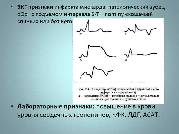 Патологический зубец q при инфаркте