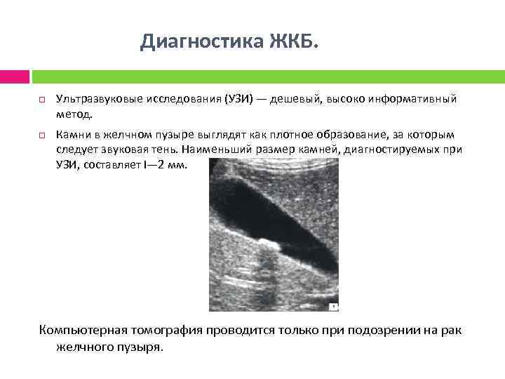  Диагностика ЖКБ. Ультразвуковые исследования (УЗИ) — дешевый, высоко информативный метод. Камни в желчном